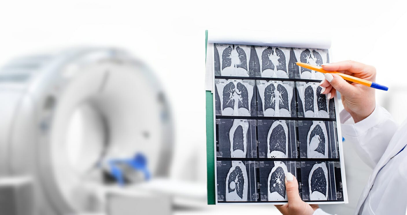 lung cancer cost of treatment
